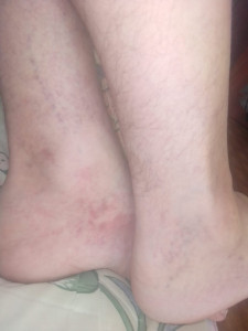 Хроническая венозная недостаточность