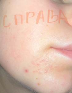 Высыпания на шее и