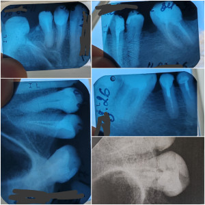 Лечение зубов перед установкой коронок
