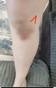 Болит колено