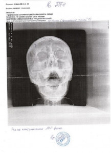 Расшифровка рентгеновского снимка