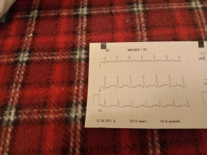 Плохое ЭКГ на фоне волнения