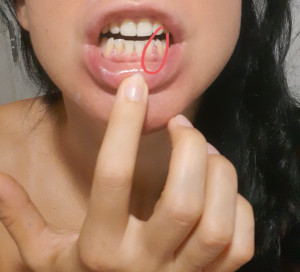 Воспалилась десна и 