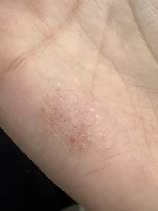 Сильный зуд ладони и пальца, волдыри