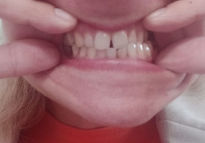 перекрестный прикус