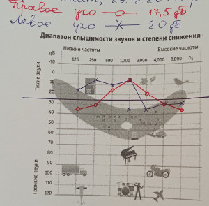 Состояние барабанных перепонок у обучающегося с минимальными расстройствами слуховых функций.