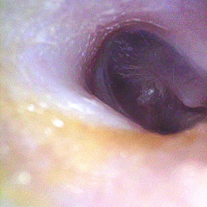 Опознавательные знаки на барабанной перепонке.