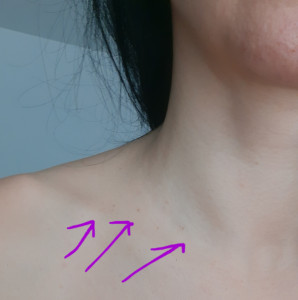 Папиллом становится больше