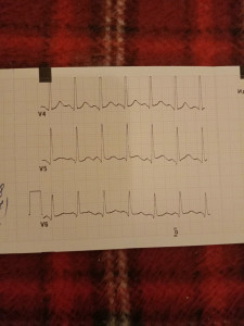 Плохое ЭКГ на фоне волнения