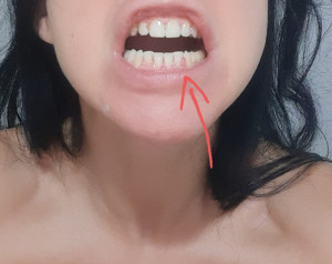 Воспалилась десна и 