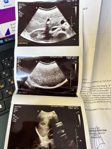 образование в печени