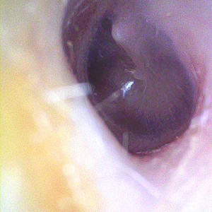 Опознавательные знаки на барабанной перепонке.