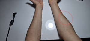 Саркома или нет?