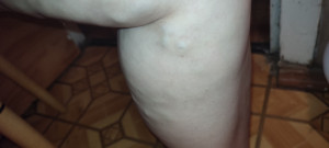 Удар венозной ноги