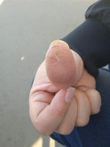 Трескается кожа на пальцах рук