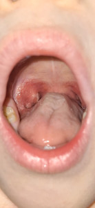 Предположение  на ангину