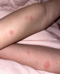 Пятна на руках