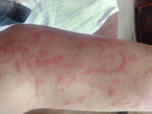 Аллергические реакции