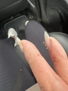 Сильный зуд ладони и пальца, волдыри