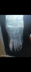 Болит стопа после перелома