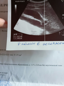 Мягкий стул, бурление в животе, спазмы