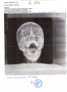 Операция носовой перегородки.