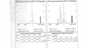 Расшифровка тимпанограммы.