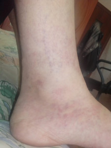 Хроническая венозная недостаточность