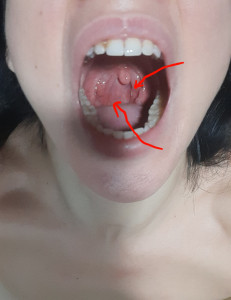 Более 2 недель не могу вылечить горло