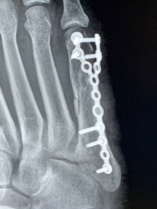Перелом 5 плюсневой кости