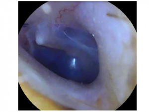 Состояние барабанных перепонок у обучающегося с минимальными расстройствами слуховых функций.