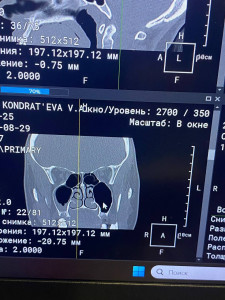 Синусит, первоначальное лечение не помогло