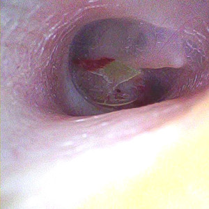 Опознавательные знаки при отоскопии.