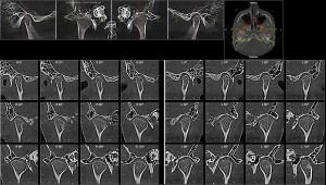 Стоит ли удалять здоровые премоляры?