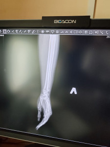 Как уменьшить боль? И что за расстояние между косточками