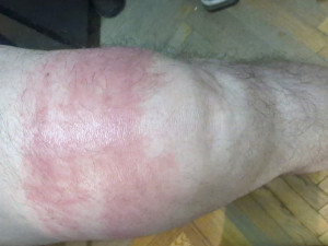 Аллергия после лекарства