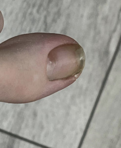 Что это за растущее пятно на коже под ногтем?