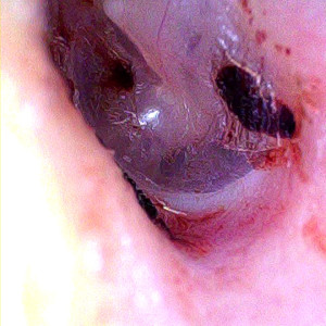 Опознавательные знаки при отоскопии.