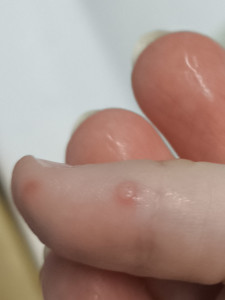 Высыпания на лице и кисти руки