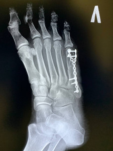 Перелом 5 плюсневой кости
