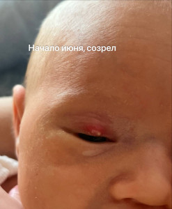 Халязион в 1,5 мес