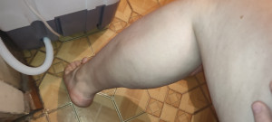 Удар венозной ноги