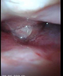 Скажите видео показать что у меня полипы ?