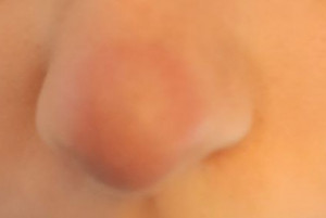 Воспаление на носу