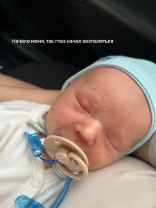 Халязион в 1,5 мес
