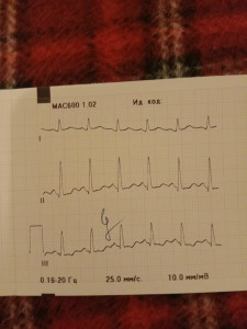 Плохое ЭКГ на фоне волнения