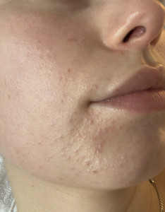 Периоральный дерматит