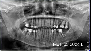 Лечение зубов перед установкой коронок