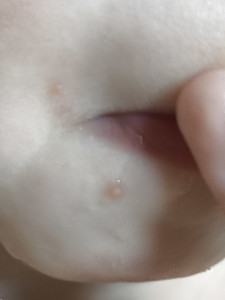 Высыпания на лице и кисти руки