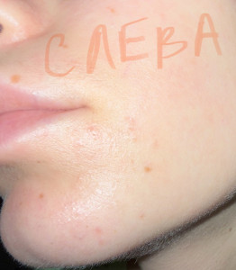 Высыпания на шее и